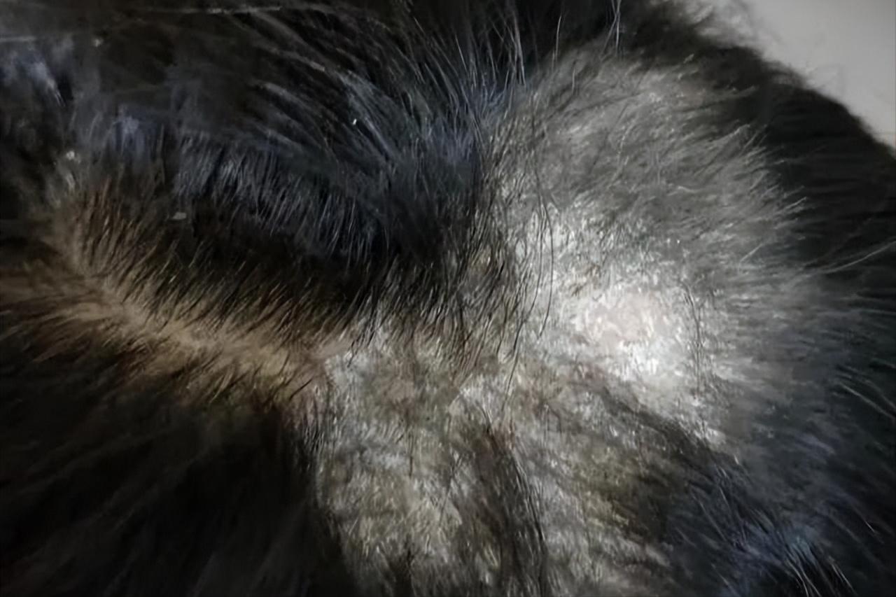 头屑多脱发怎么去除小妙招,头屑如何调理生发最有效