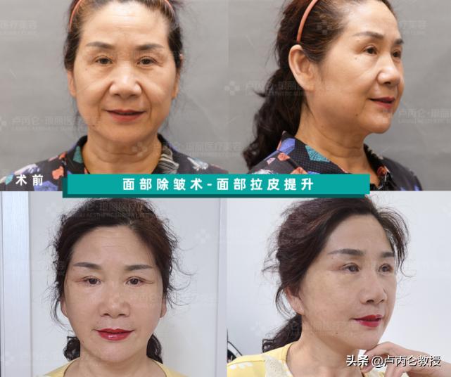 拉皮除皱手术有哪些,拉皮除皱手术的危害