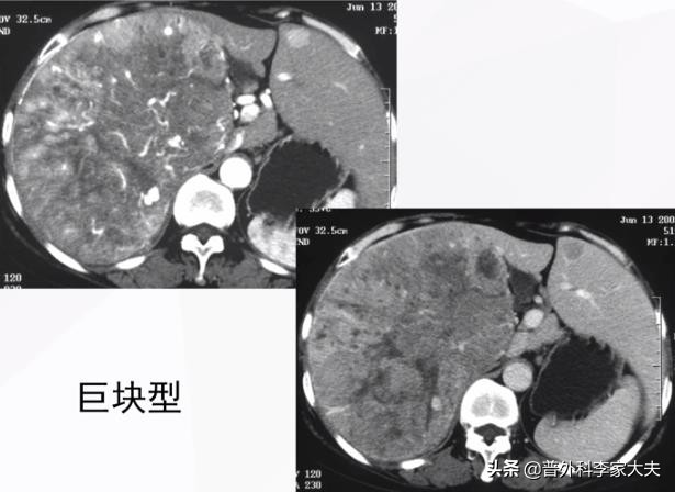 肝癌晚期吃的靶向药报销吗,新农合可报销的肝癌最新靶向药