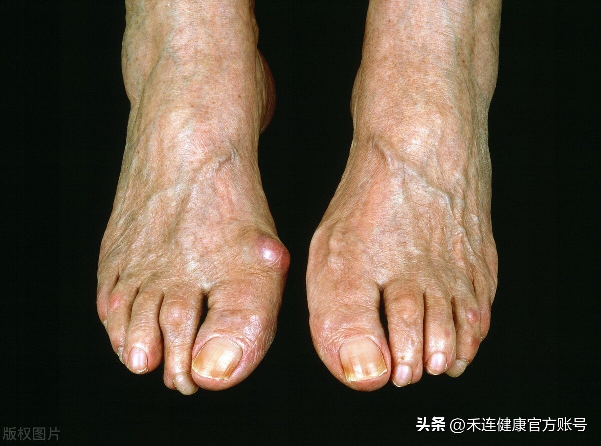 大脚趾凸起疼痛怎么回事,如何预防大脚趾凸出疼痛