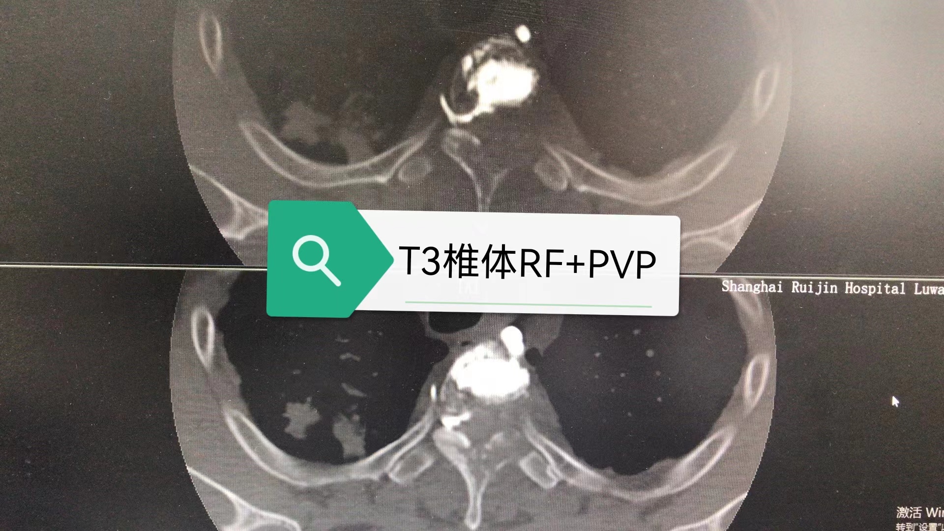 病例Ⅴ：RF+PVP联合治疗高位胸椎溶骨性转移瘤及压缩骨折