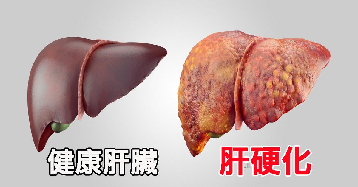 李兰娟院士谈乙肝病毒存活时间,李兰娟院士谈乙肝抗病毒治疗