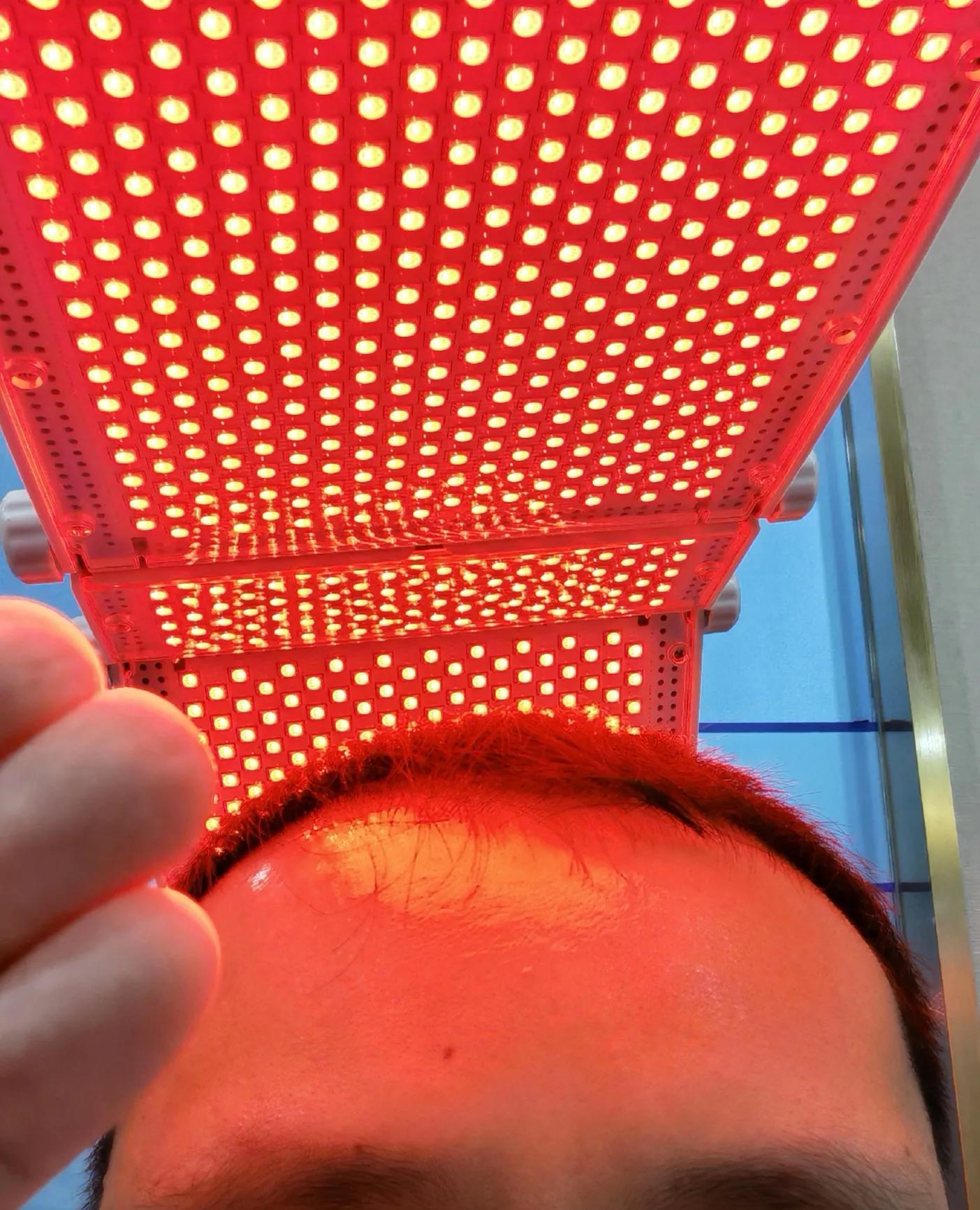 雄脱植发的亲身经历和感受,16000字讲述植发真实感受