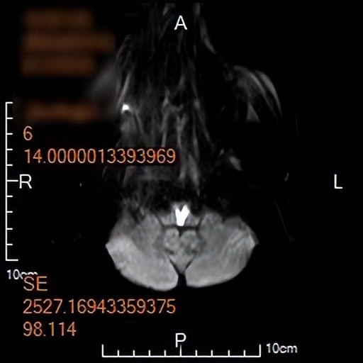 河北保定:市第一中心医院成功救治一例罕见的“心形”脑梗死患者