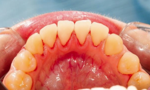 蛀牙痛怎么快速止痛该吃什么药,哺乳期牙痛吃什么药可以止痛