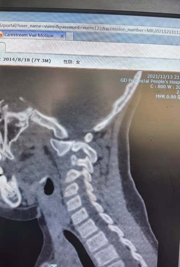儿童落枕最快恢复办法,落枕了30秒自愈方法儿童
