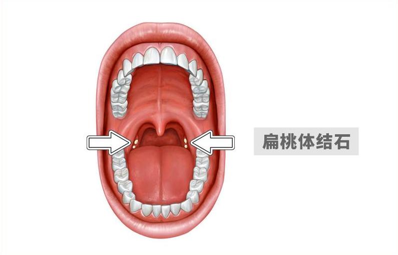 喉咙有异物感咳一下喉咙容易出血,喉咙有异物咳出水老是想咳