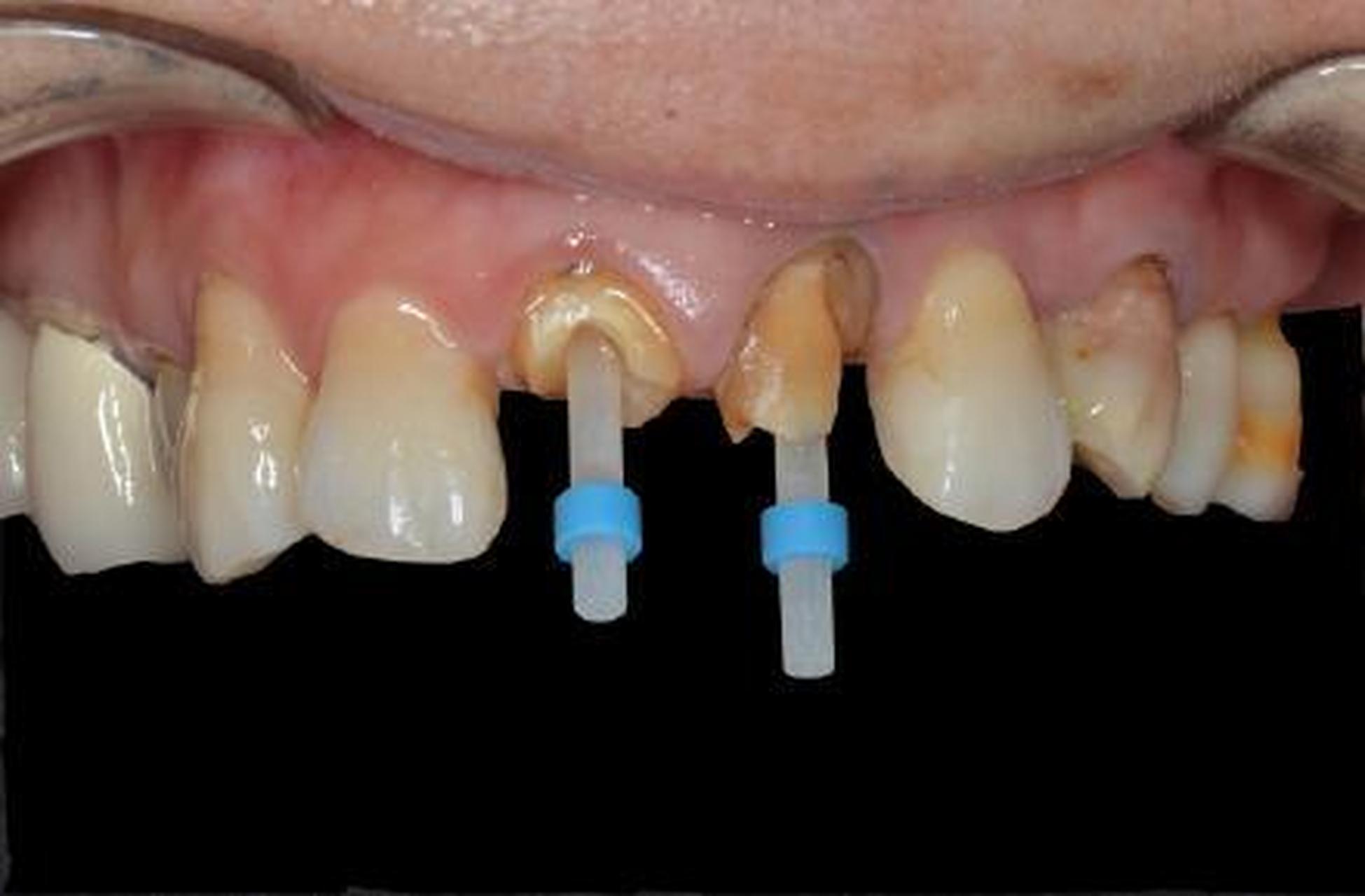 牙齿隐裂牙根完好可以保住么,牙齿蛀虫后只剩牙根要不要拔掉