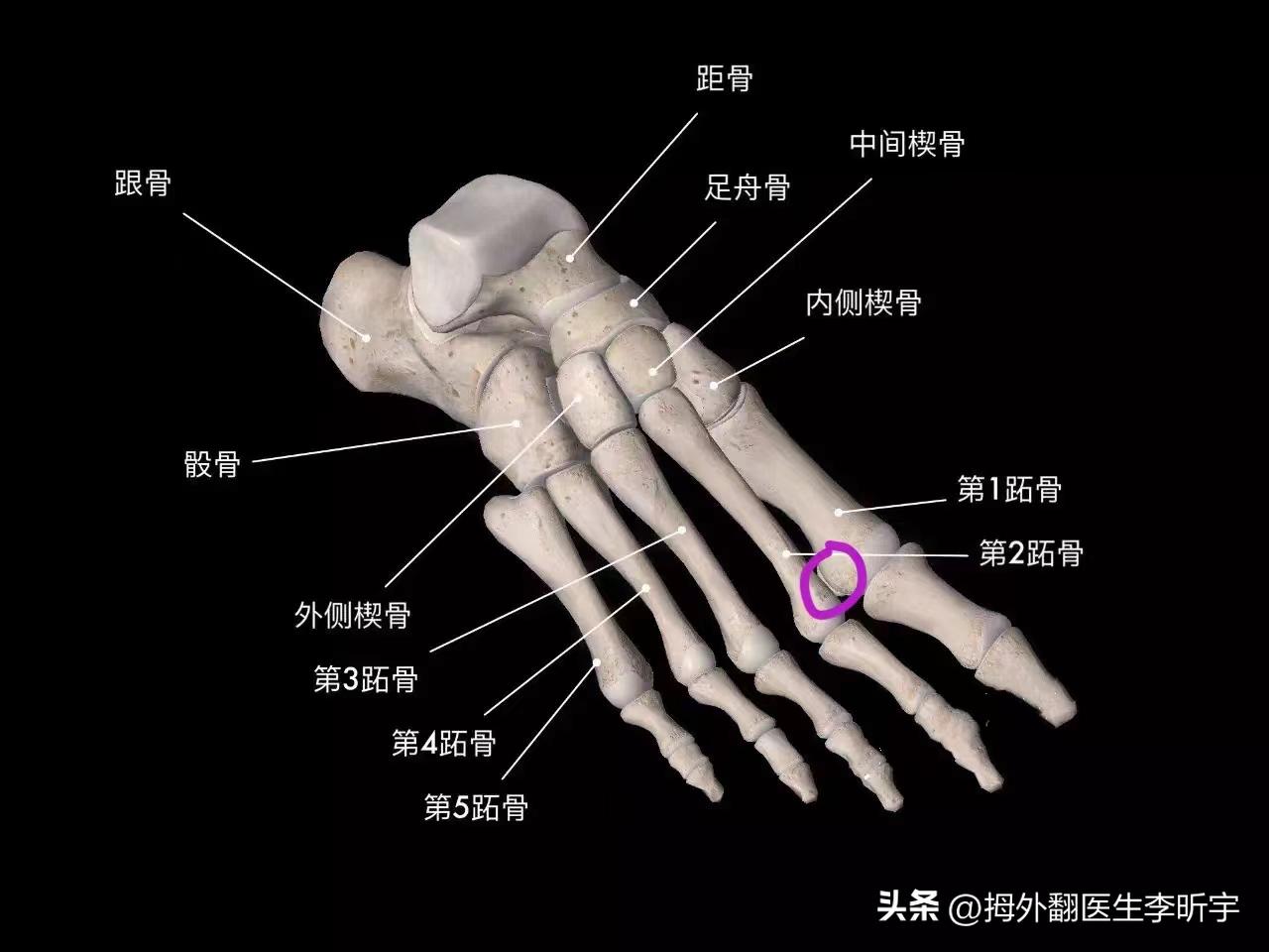 拇外翻矫正器真的有用吗,拇指外翻矫正器是智商税吗