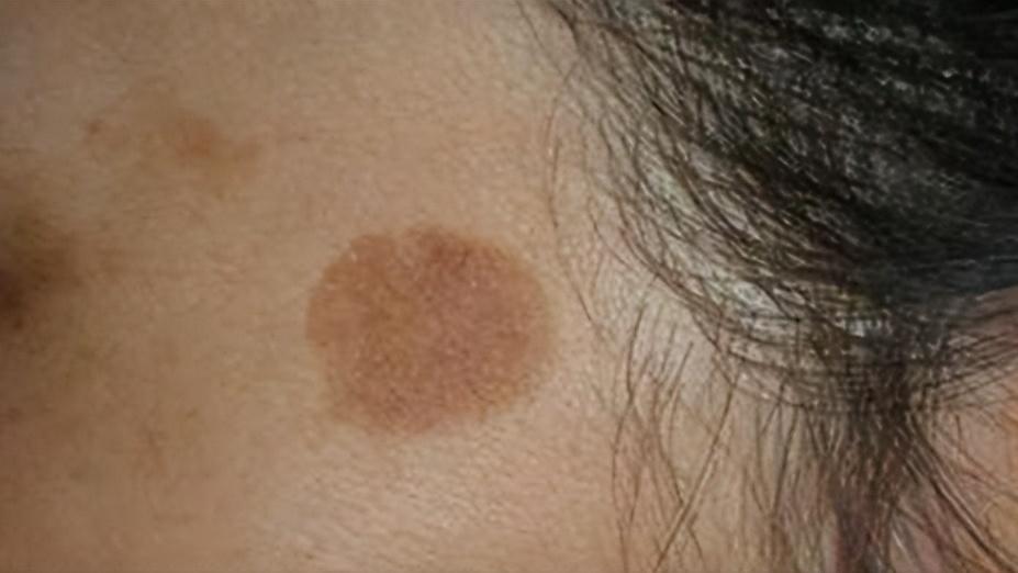 红霉素软膏能去除老年斑吗,红霉素软膏能治好老年斑吗