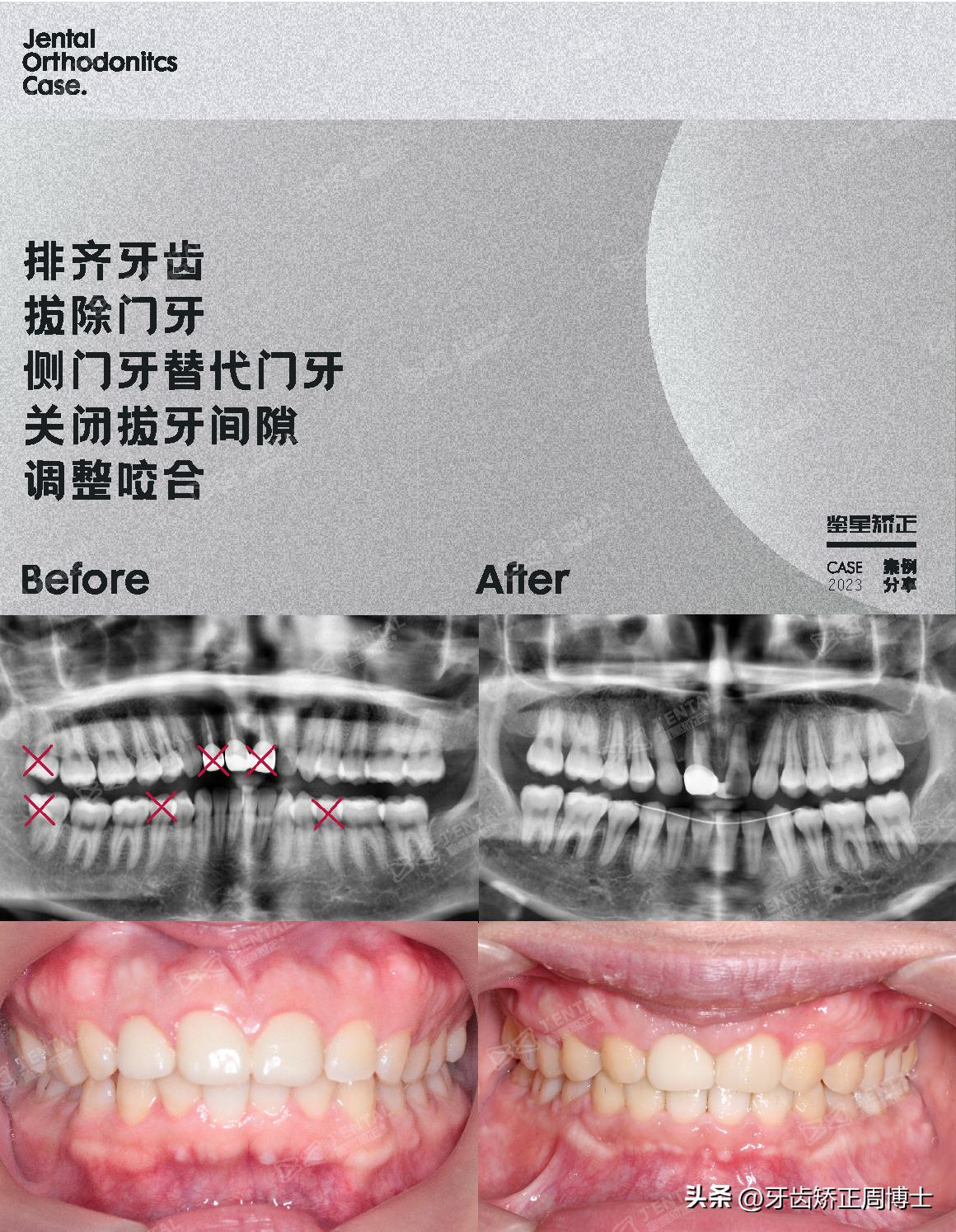 骨性上颌前凸嘴怎么矫正,厚嘴唇与嘴凸有关吗