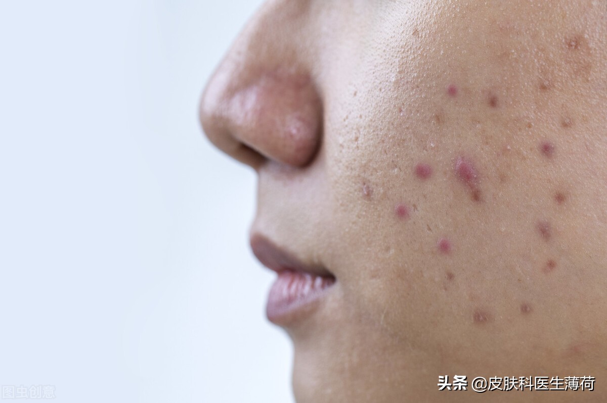 爆痘后如何有效预防痘印生成,长痘留下的痘印怎么去掉