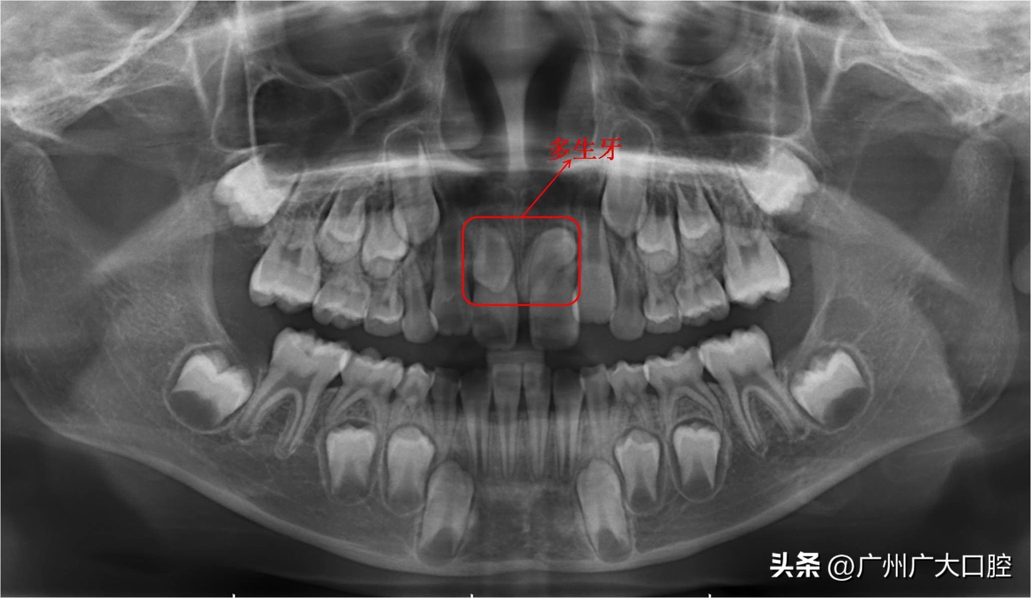 小孩换牙一直长不出怎么办,孩子换牙迟迟不长出来怎么办