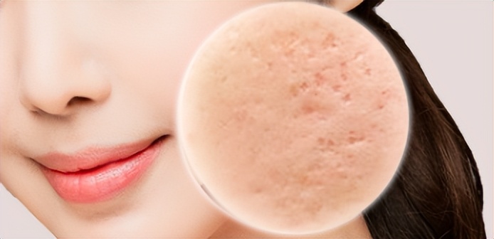 痘痘是怎么引起的如何有效祛痘,痘痘反复长教你如何祛痘简单有效