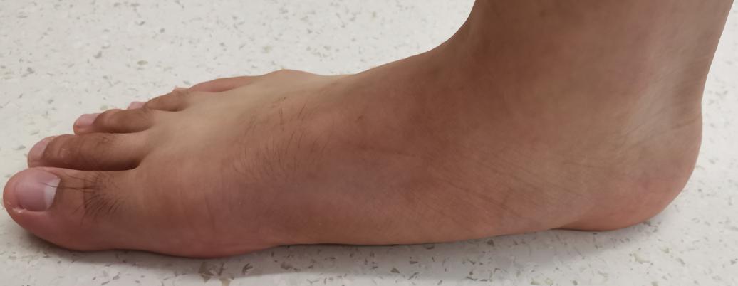 距下关节制动术成人效果如何,距下关节制动器作用