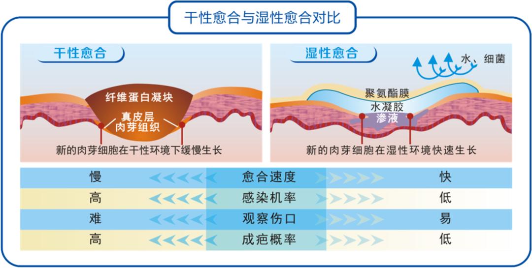 伤口湿性愈合和干性愈合的区别,干性愈合过程