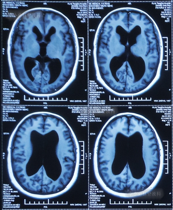 脑积水手术后4天还呕吐怎么回事,脑积水分流术后一直腹部疼痛