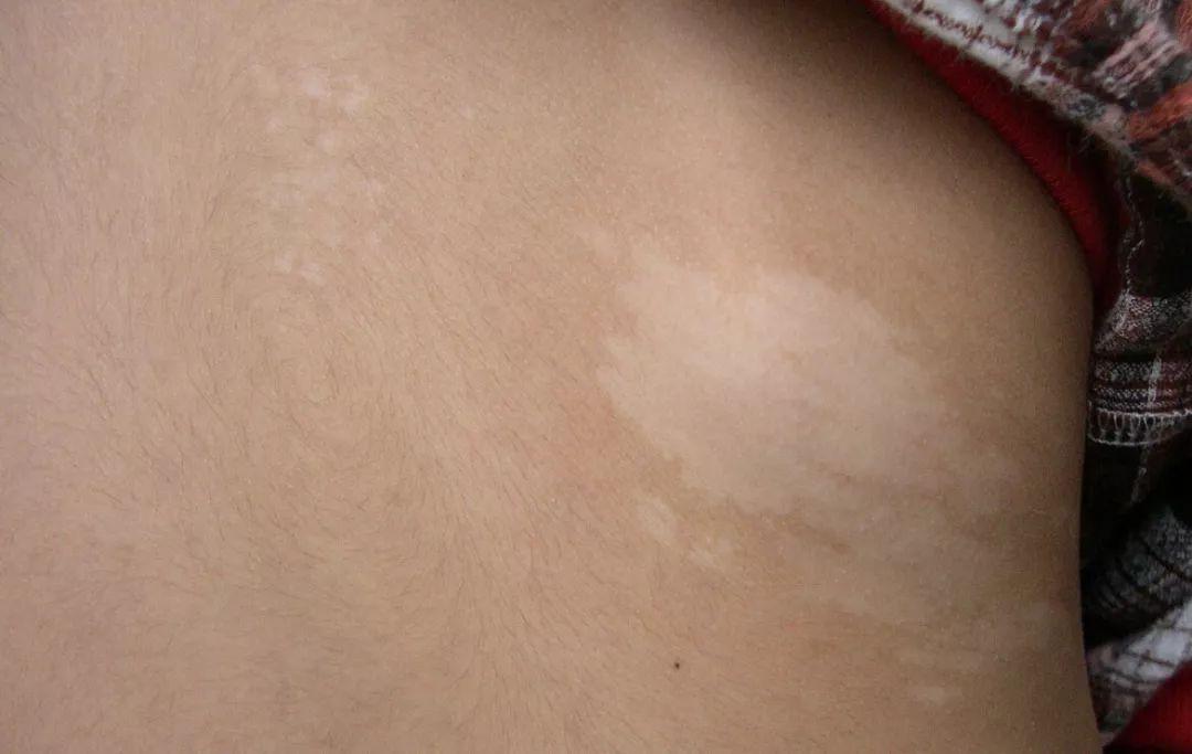 有什么白斑是不用治疗的,白斑怎样治疗才能消失呢