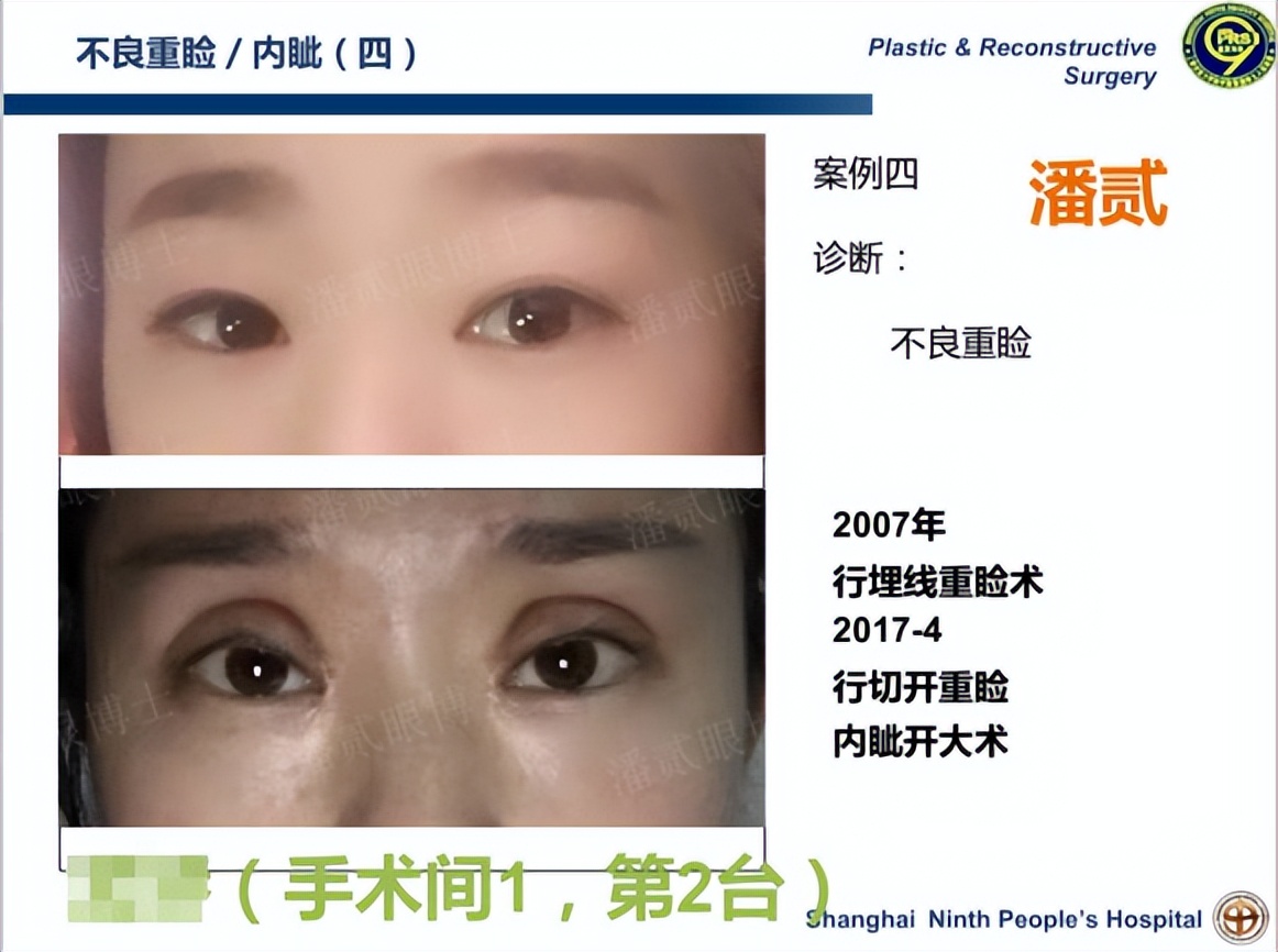 上海宽改窄双眼皮修复案例对比,宽变窄双眼皮修复过程对比