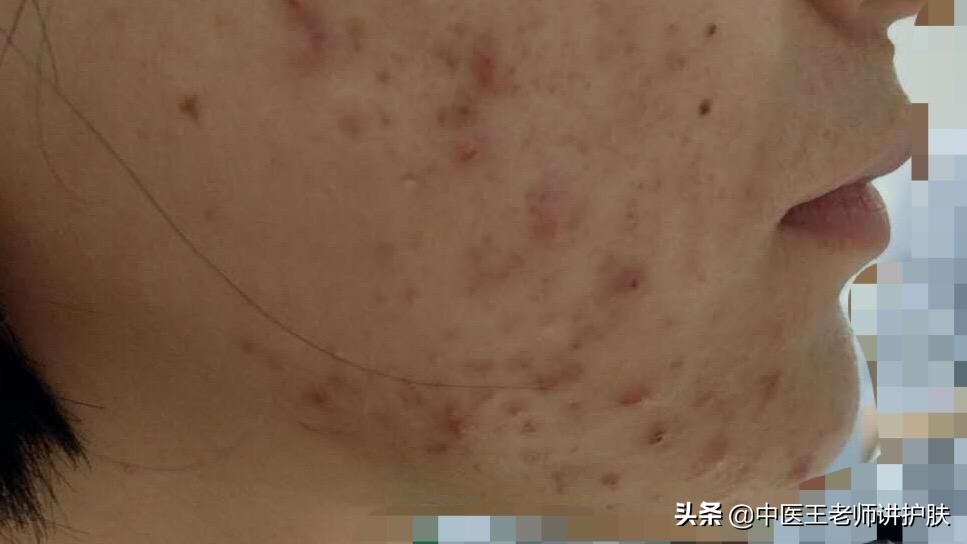 治毒疮最快的中医偏方,治疗各种疮的偏方