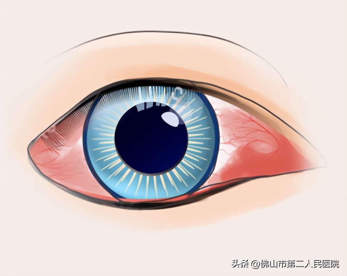 熬夜醒来眼圈红是什么原因,熬夜醒来眼睛有血丝