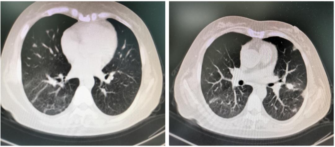 劳累引起发烧反复,劳累后发热属于气虚发热么