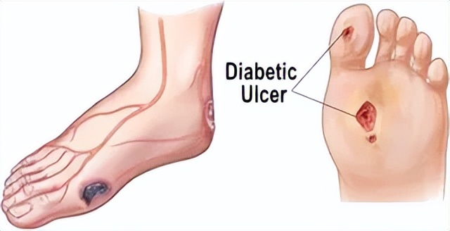 世界糖尿病日小知识,世界糖尿病日活动方案选品