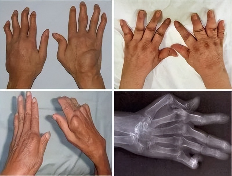 风湿骨病一般是痛在哪些部位,风湿骨病造成关节疼是哪里疼