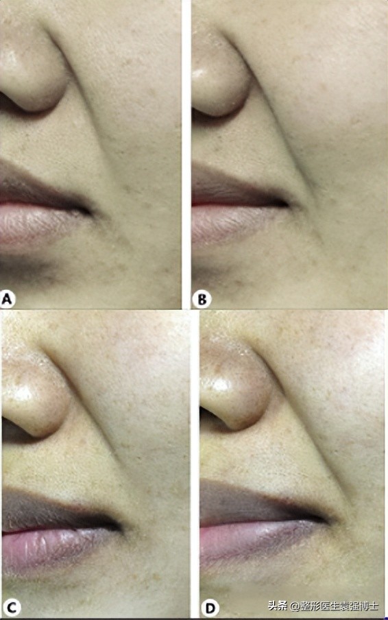 治法令纹有什么妙招,有法令纹做什么效果比较好