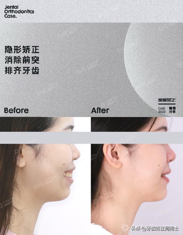 隐形矫正龅牙效果图,严重龅牙可以用隐形矫正吗