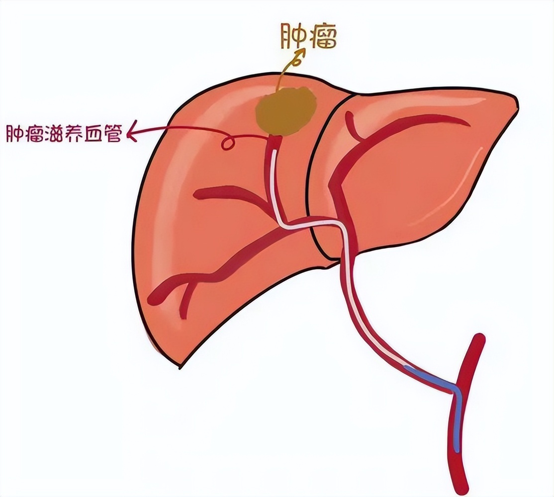 半夜吃烧烤会得癌症吗,经常吃烧烤致什么癌症