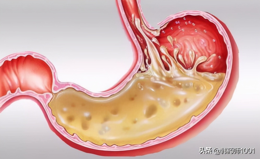 长期吃碳酸氢钠片会发胖吗,长期吃碳酸氢钠片有副作用吗