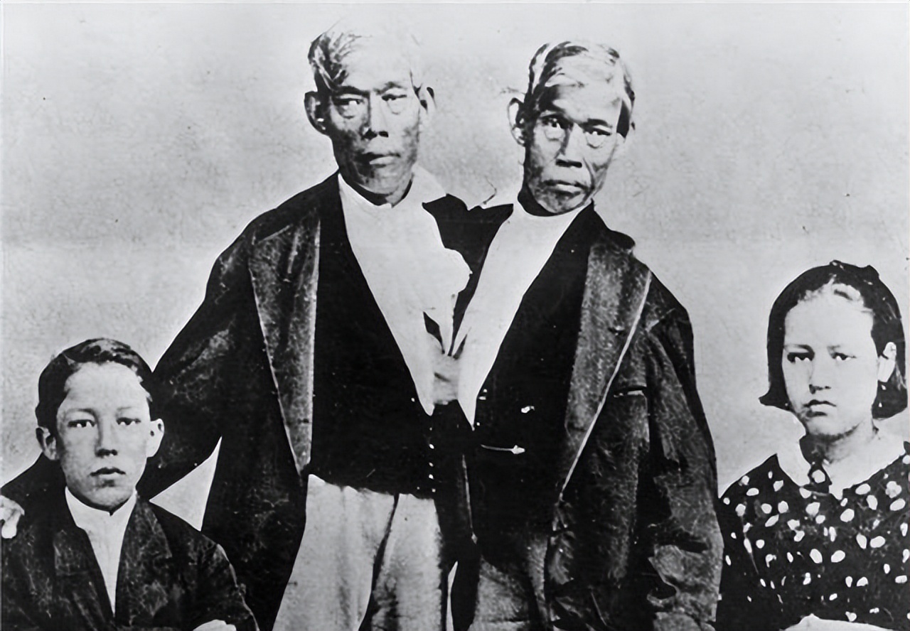 连体兄弟真的存在吗,印度连体兄弟被奉为神灵不想分离