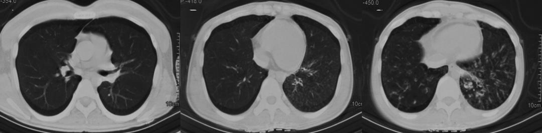 婴儿间断性咳嗽是怎么回事,儿童咳嗽肺部有微小结节有事吗