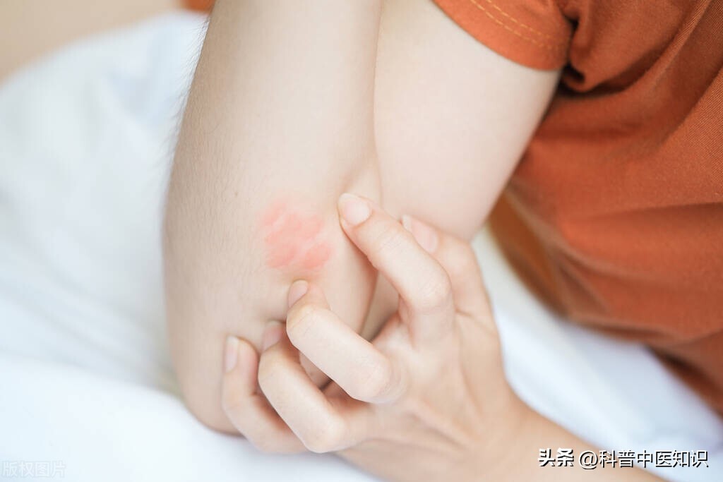 全身瘙痒中医辨证论治,全身瘙痒的中成药