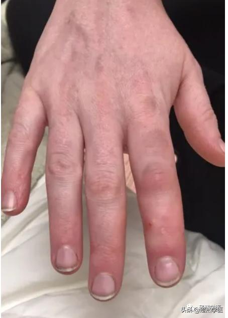 被鱼刺扎伤了怎么处理,被鱼扎伤手指如何处理