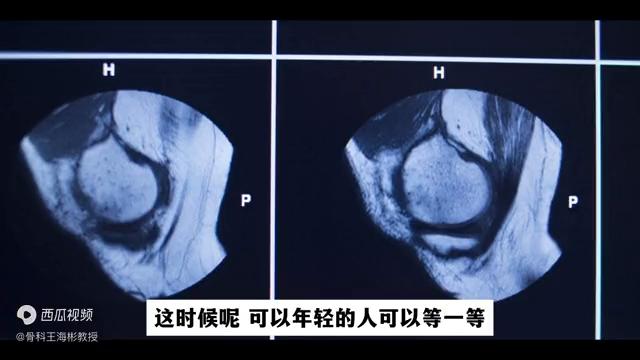 半月板损伤不做手术有什么好办法,半月板二度损伤静养三周变成三度
