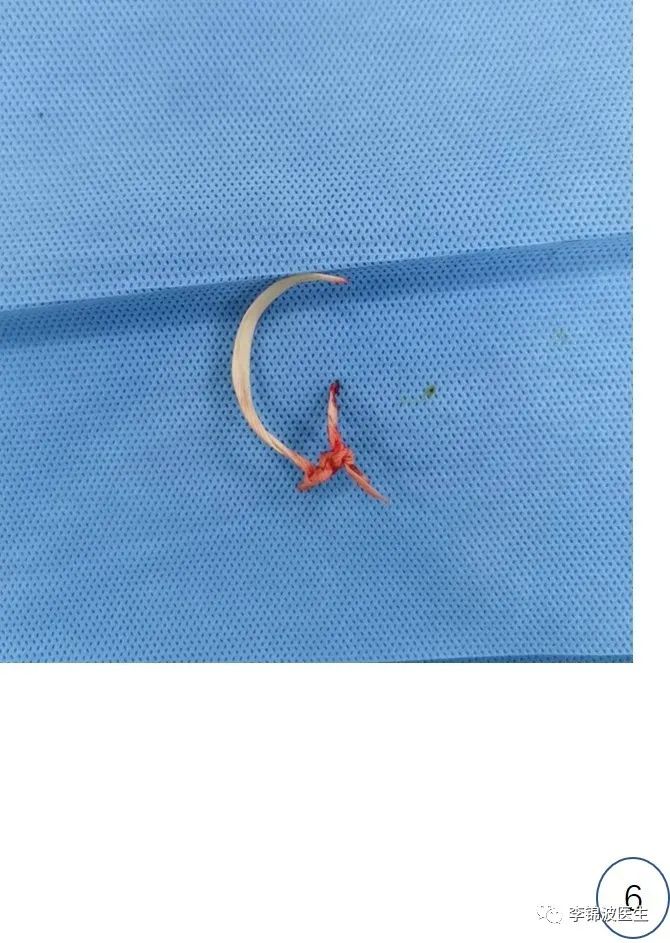 拆除高位宫颈环扎线的步骤和注意事项