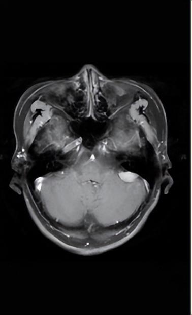 脑膜瘤头疼吃什么中药,脑膜瘤头疼怎么办