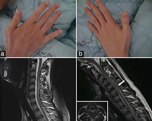 手腕无力手指笨拙虎口萎缩,手臂手掌无力萎缩的症状