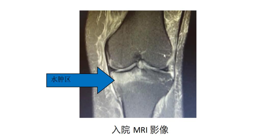 怎么做才能快速治愈膝关节炎,治疗膝骨关节炎最新技术