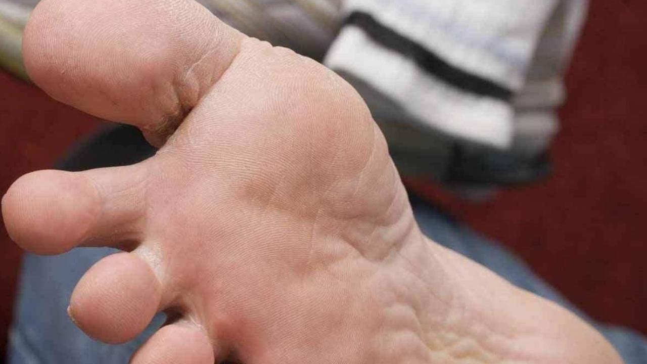 脚底板爱紫是什么原因,脚底板爱起皮是怎么回事