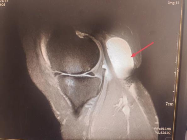 关节镜下切除腘窝囊肿要多少费用,膝关节镜下腘窝囊肿切除的原理