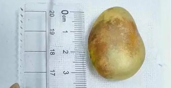 不小心吞了菠萝蜜的核第二天想吐,女子误吞枣核两年才取出来