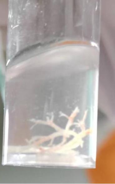 气管上长了一个疙瘩,气管里长了一个瘤