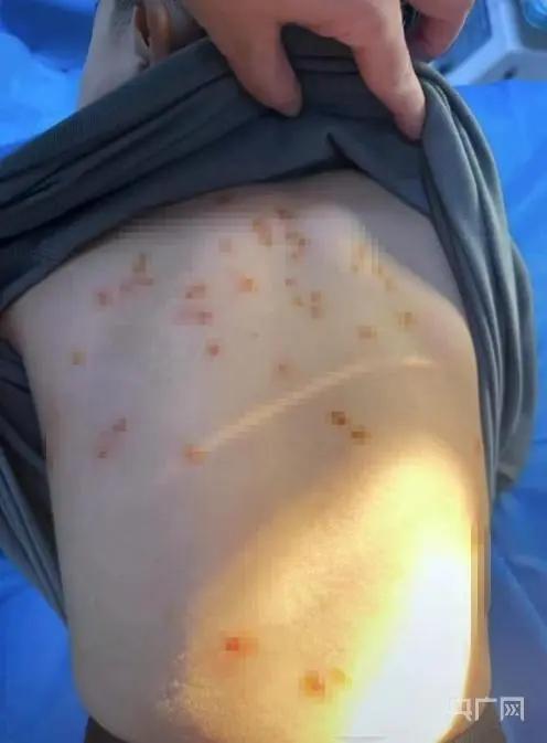 泡温泉感染hpv的几率大吗,泡温泉后感染了hpv