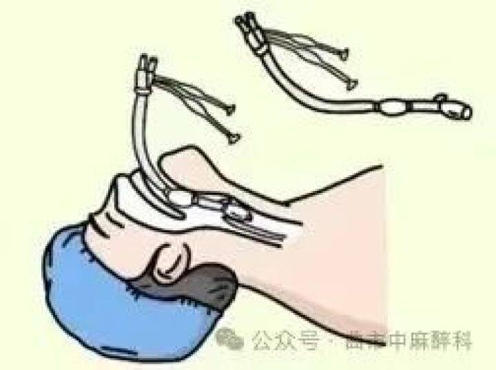 曲靖市中医医院成功开展Tubeless新技术，为患者康复加速助力