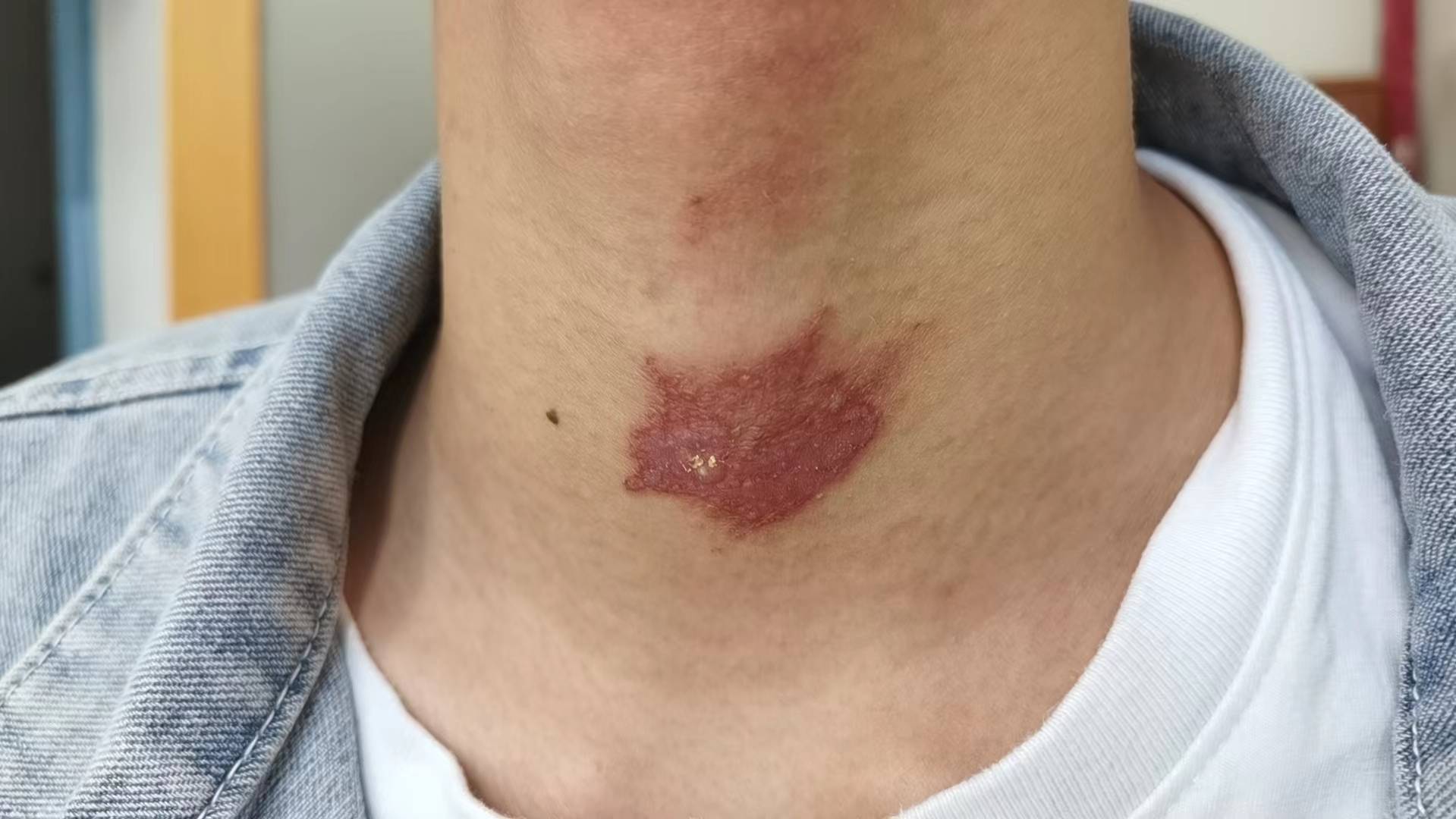 隐翅虫安全知识,当心隐翅虫