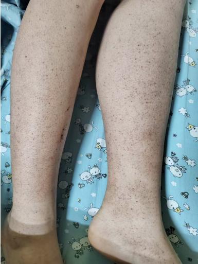 小孩子腿上有斑点怎么回事,小孩腿上有少许紫色斑点严重吗