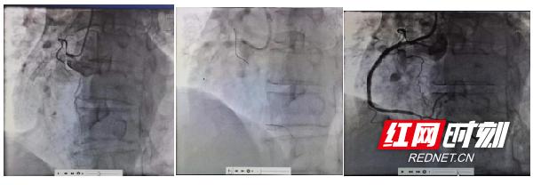 冠状动脉斑块消除最新科技,准分子激光冠脉斑块消蚀术